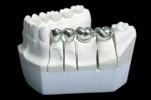 palladium in dentistry