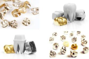 precious metals in dentistry
